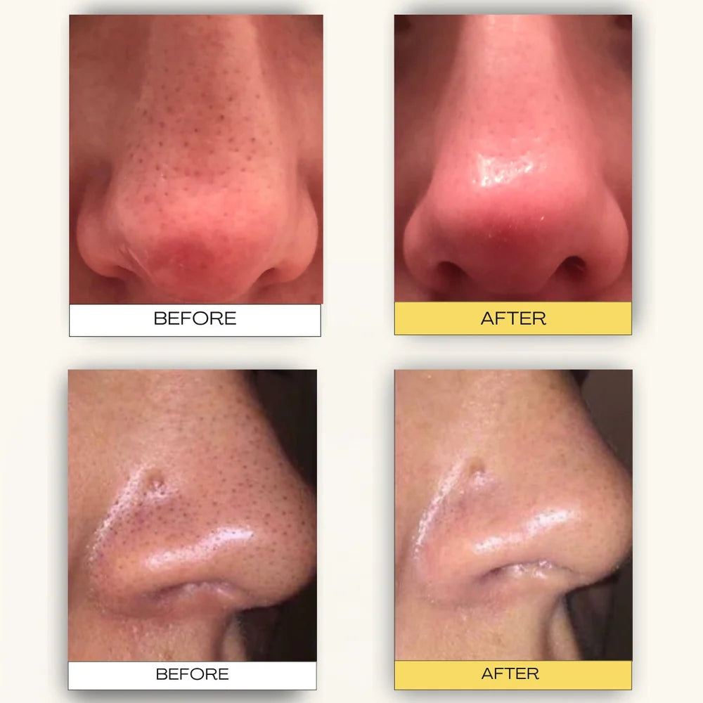 Deep Cleansing Patch System