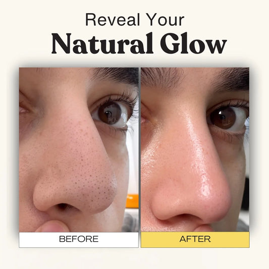 Luelle Pore Cleasing Patch System