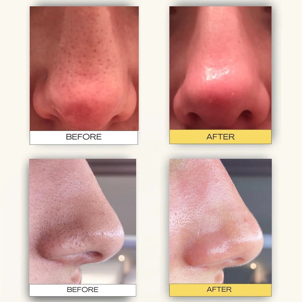 Luelle Pore Cleasing Patch System