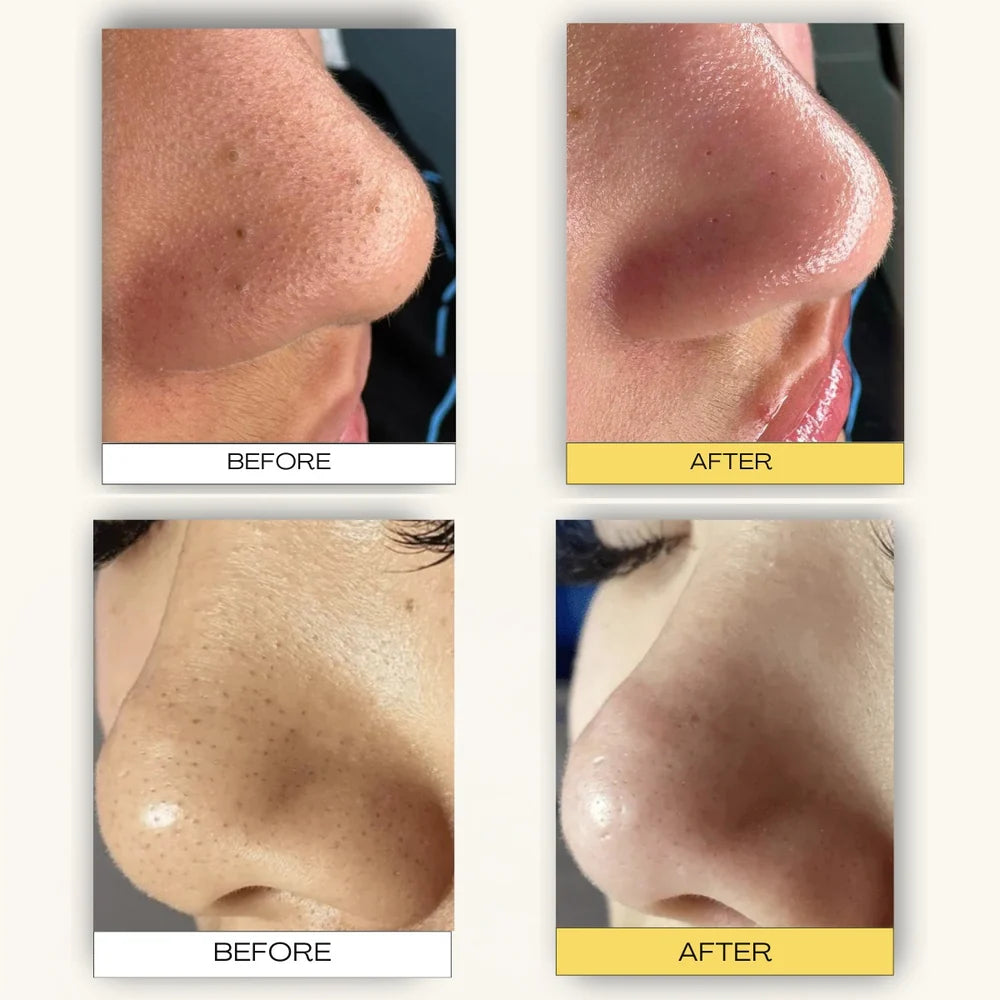 Luelle Pore Cleasing Patch System