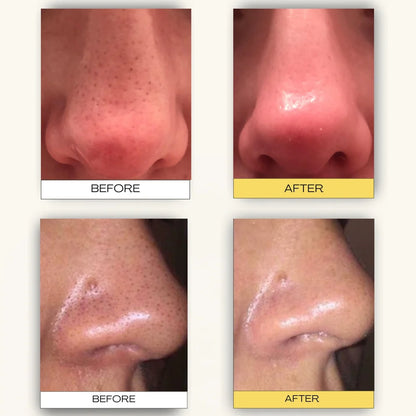 Deep Cleansing Patch System
